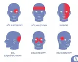 Ilustracja przedstawia sześć schematycznych głów z zaznaczonymi czerwonymi obszarami bólu: klasterowy, napięciowy, migrena, szyjnopochodny, zatokowy, skroniowy.