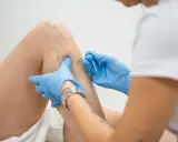 Terapeuta w niebieskich rękawiczkach wykonuje zabieg suche igłowanie na kolanie pacjenta, celując w punkty bólowe.