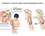 Ilustracja pokazuje uszkodzenie i zerwanie ścięgna bicepsa, powodujące ból bicepsa i objaw Popeya.