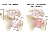 Porównanie zdrowego stawu barkowego z objawami zamrożonego barku: pogrubiała i usztywniona torebka stawowa.