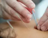 Dłonie terapeuty wprowadzają igły do akupunktury. Często zadajemy sobie pytanie, jak często stosować suche igłowanie dla najlepszych efektów.