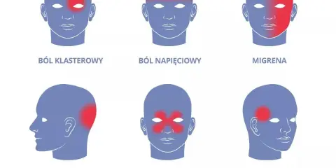 Ilustracja przedstawia sześć schematycznych głów z zaznaczonymi czerwonymi obszarami bólu: klasterowy, napięciowy, migrena, szyjnopochodny, zatokowy, skroniowy.