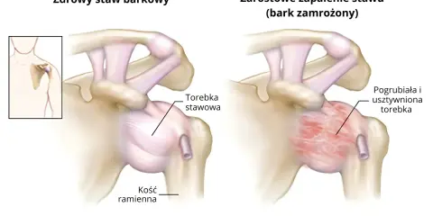 Porównanie zdrowego stawu barkowego z objawami zamrożonego barku: pogrubiała i usztywniona torebka stawowa.