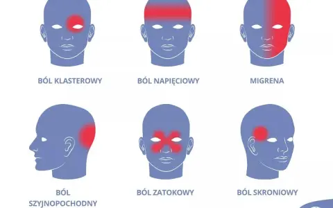 Ilustracja przedstawia sześć schematycznych głów z zaznaczonymi czerwonymi obszarami bólu: klasterowy, napięciowy, migrena, szyjnopochodny, zatokowy, skroniowy.