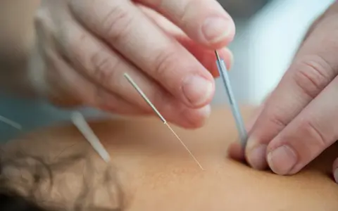 Dłonie terapeuty wprowadzają igły do akupunktury. Często zadajemy sobie pytanie, jak często stosować suche igłowanie dla najlepszych efektów.