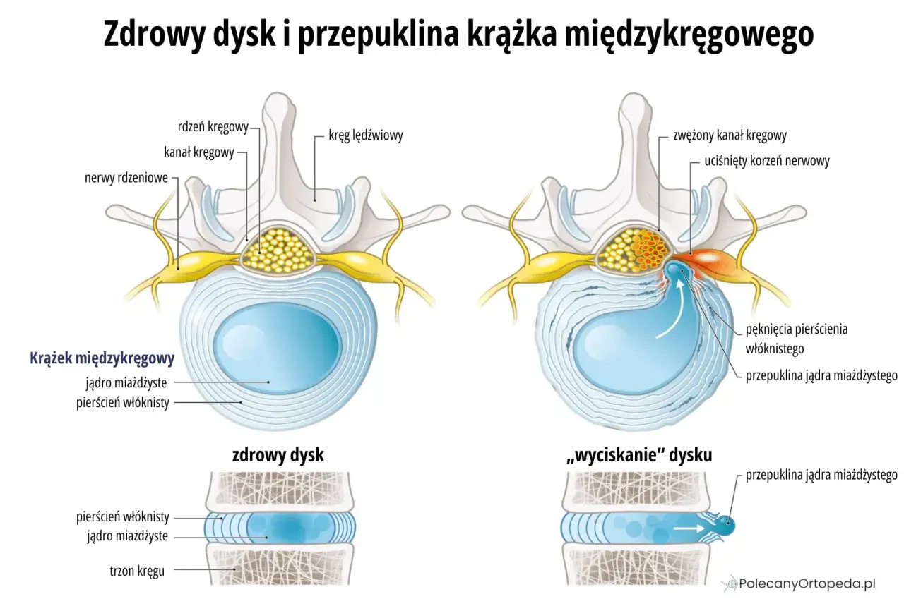 Porównanie zdrowego dysku z przepukliną jądra miażdżystego na poziomie L4-L5, uciskającą korzeń nerwowy.